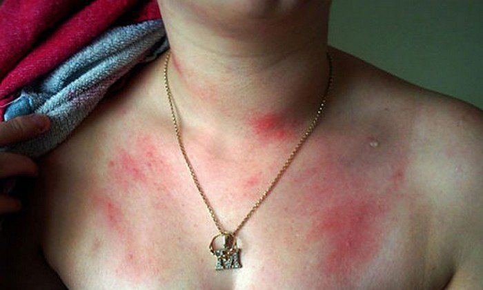 Аллергия на воду: крапивница