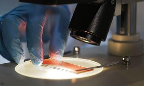 Испытание генной терапии заметно снижает риск кровотечения у пациентов с гемофилией B